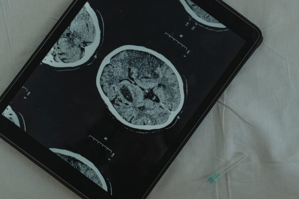MRI מוח