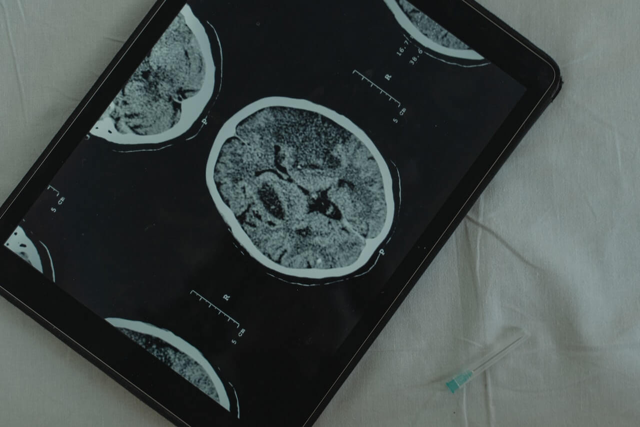 MRI מוח